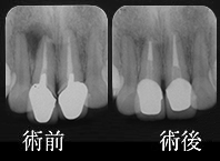 前歯の治療